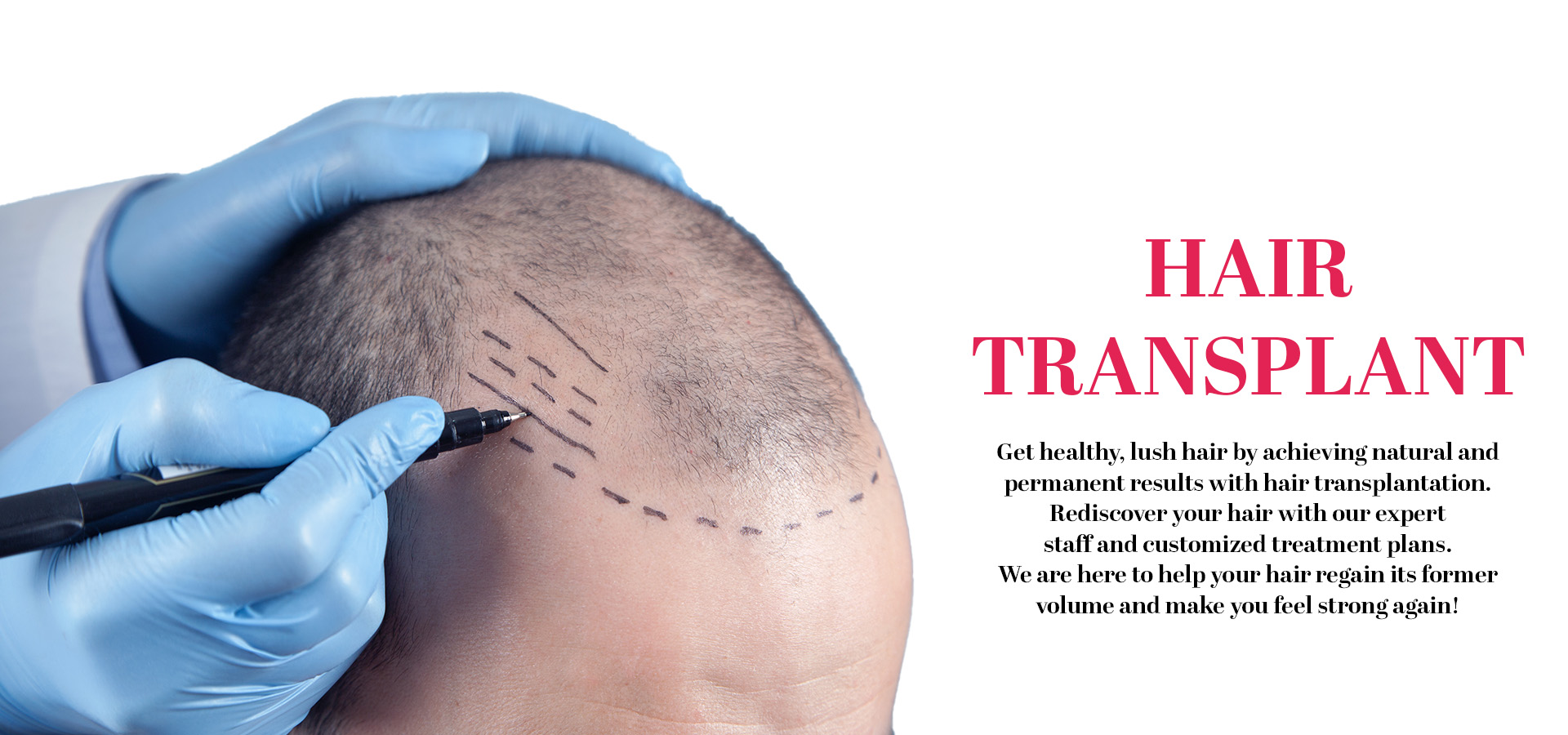 ayz hair transplant ingilizce